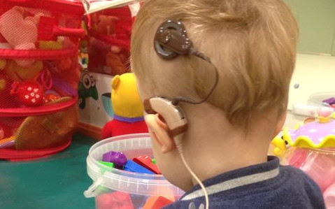 Foto implante coclear. Foto: San Francisco de Sales Hipoacúsicos 